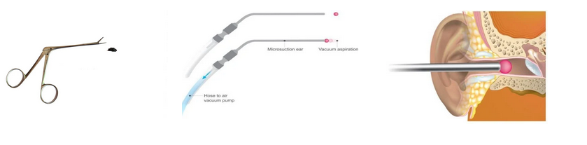 Advanced Techniques for Ear wax removal: Innovative Care for Blocked Ears post thumbnail image