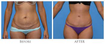 Recovering from Abdominoplasty Surgery in Miami post thumbnail image