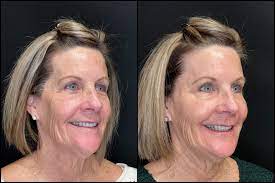 How Laser Hair Removal is Revolutionizing Splendor Treatments post thumbnail image