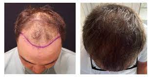 Why Toronto Is Becoming a Go-To Destination for International Hair Transplant Patients post thumbnail image